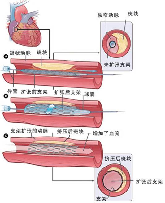 怎樣治療冠心病？(圖2)